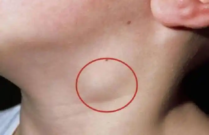 锁骨|淋巴结|身体_新浪新闻