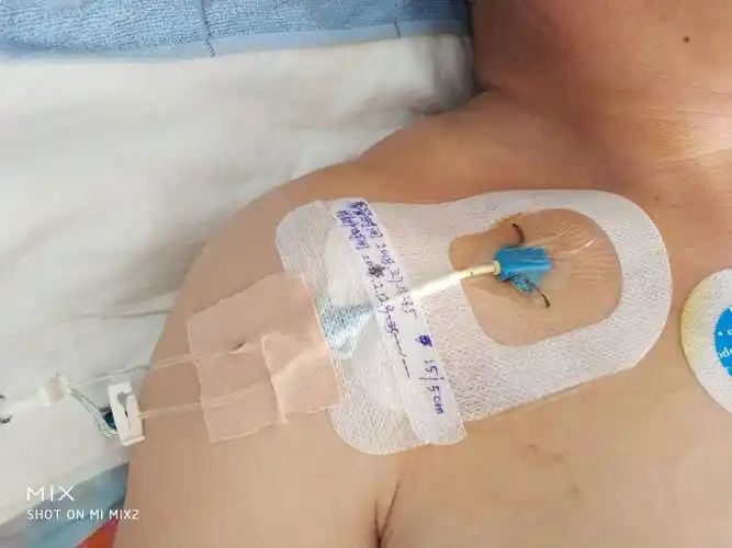 神经外科熟练掌握中心静脉穿刺置管技术在临床中的应用