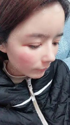 眼综合术后7天_眼部整形术后7天_小龙堡分享图片2