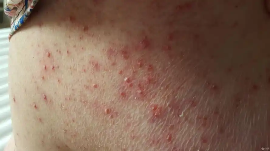 全身躯干四肢皮疹求诊断
