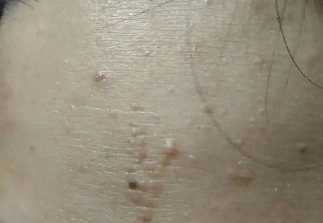 16岁女生手臂上长"菜花",被母亲痛骂,医生为母亲检查发现真相