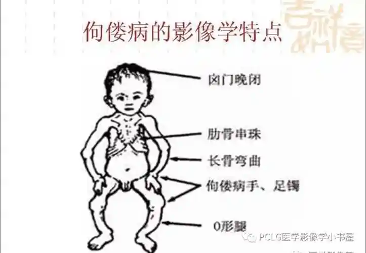 病例21——佝偻病