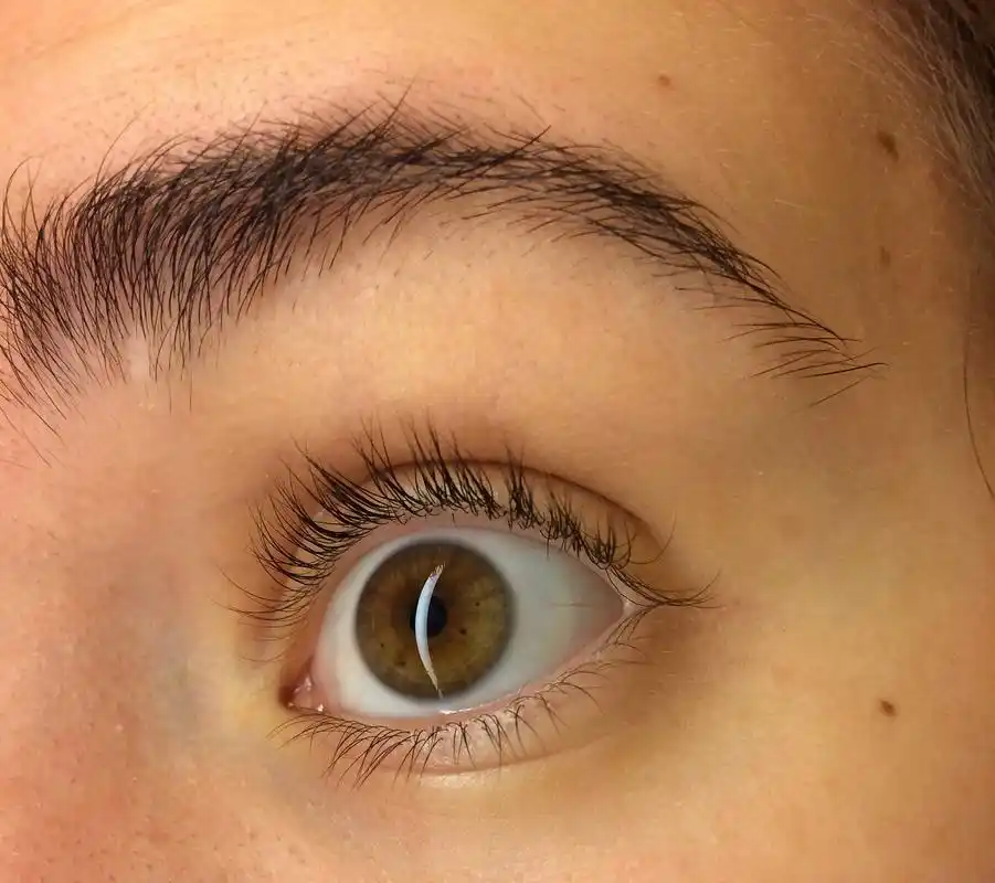 倒睫毛的出现影响了眼部健康,采用合适的手术方案可以予以矫正