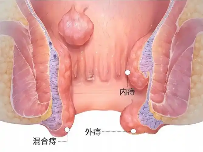 痔疮前期症状图片