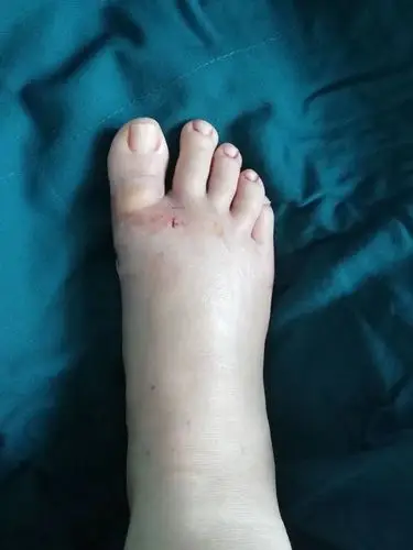 改良小切口拇外翻的病例 - 好大夫在线