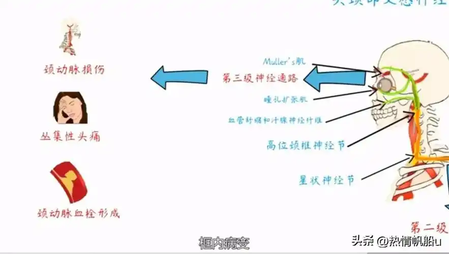 霍纳综合征一概念霍纳综合征horner综合征又称小儿颈交