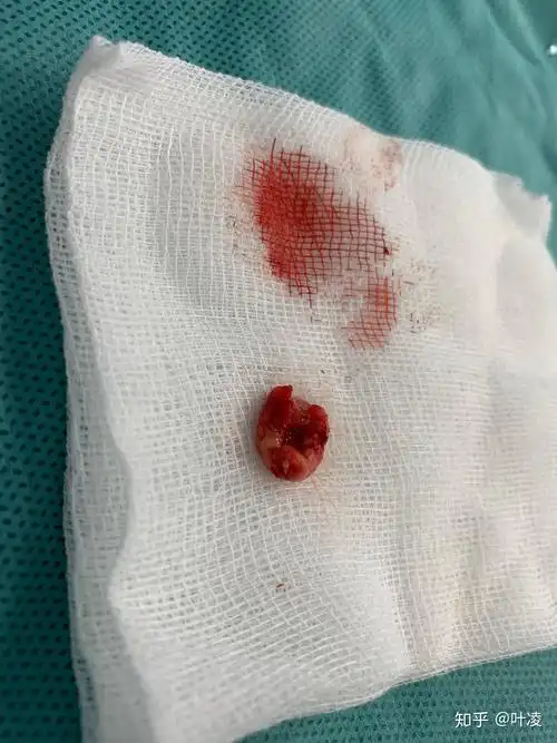 记一次根尖囊肿手术 - 知乎