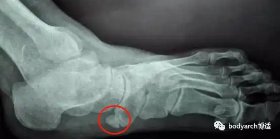 什么是副舟骨01不知道怎么办才好了.这一下子让婷婷妈着急起来!