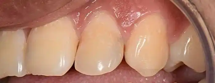 病例分享前牙邻面龋的治疗技巧