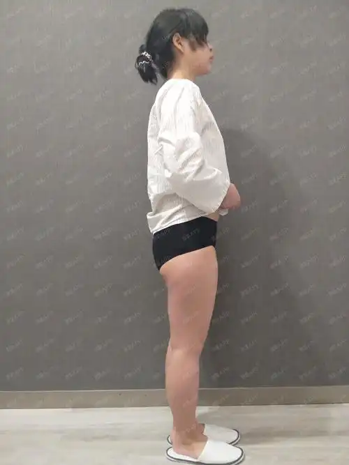 这位爱美者由于上班长期久坐,引起大腿脂肪堆积,假胯_圈子-新氧美容