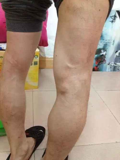 膝盖后窝生了个小肉瘤,蹲下后站立起来有轻微痛感,按压无痛感,请问是