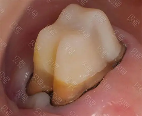 烤瓷牙发黑有必要重做吗?牙龈都发黑了还不换你可长点心吧!