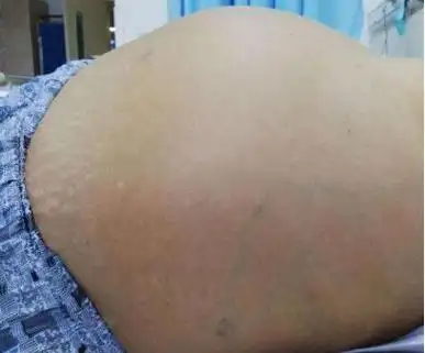 肚子里积水=腹水?从中医入手,如何治疗腹水