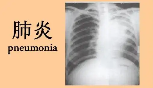 内科学名词解释(呼吸系统疾病)_小叶性肺炎