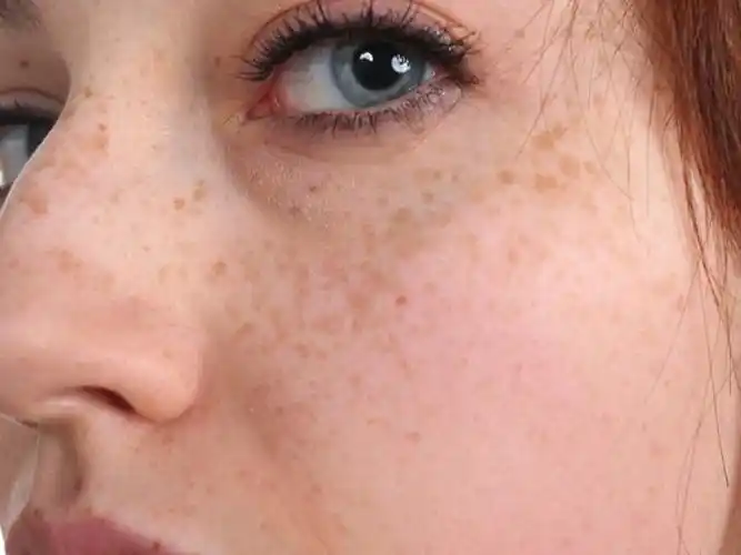 皮秒激光,与雀斑,黄褐斑说再也不见!