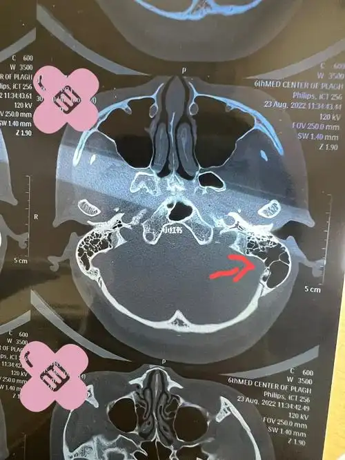 乙状窦骨壁缺损 搏动性耳鸣 我住院啦