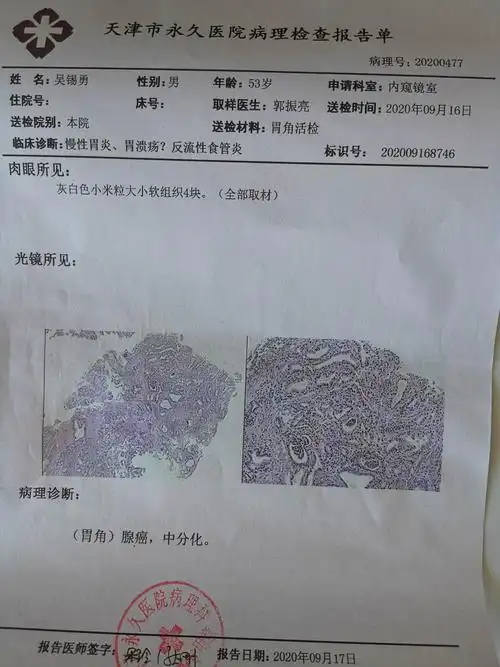 外一38床 吴** 胃癌患者病情介绍