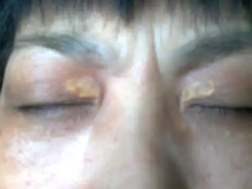 我妈两个眼角内侧长有指甲盖大小白黄色的东西,有图片,请各位大虾,好