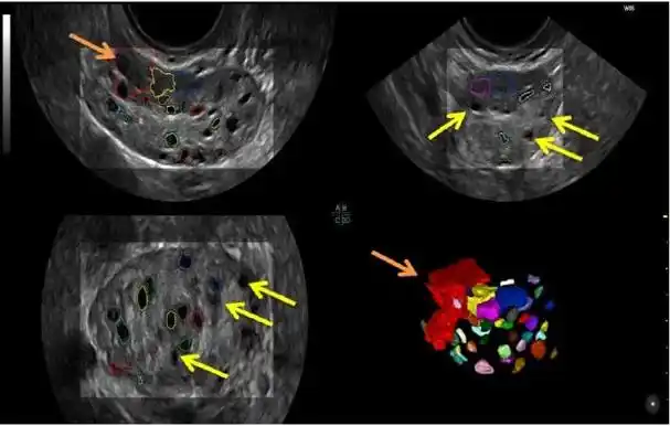 窦卵泡计数:哪种超声技术更可靠?