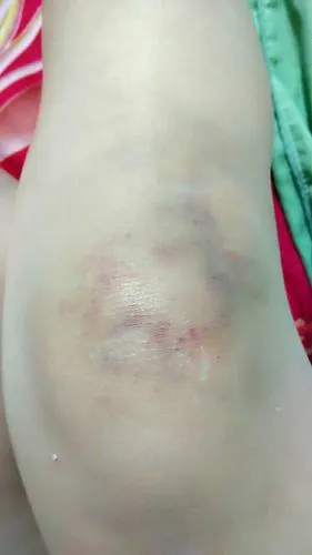 我的腿爱伤了,用鸡蛋敷,那是怎么敷了