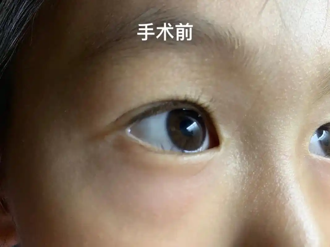 前后变化 #倒睫毛手术 七天拆线倒睫手术已完成73 - 抖音