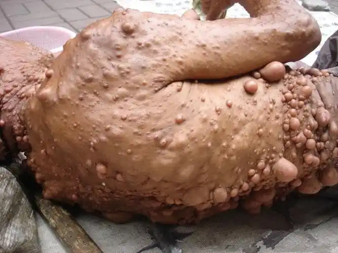 神经纤维瘤早期图片_有来医生