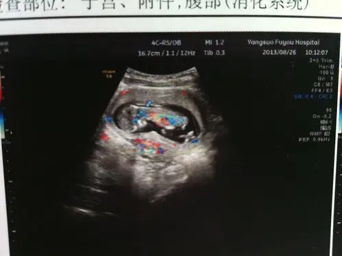 三个月b超图像,大家帮忙看看是男孩还是女孩?非常感谢!