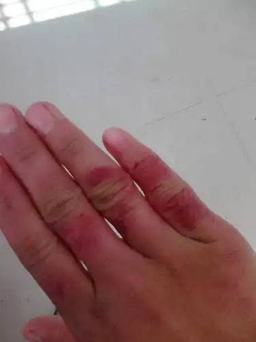 手冻成这样子了,怎样能把手变好?