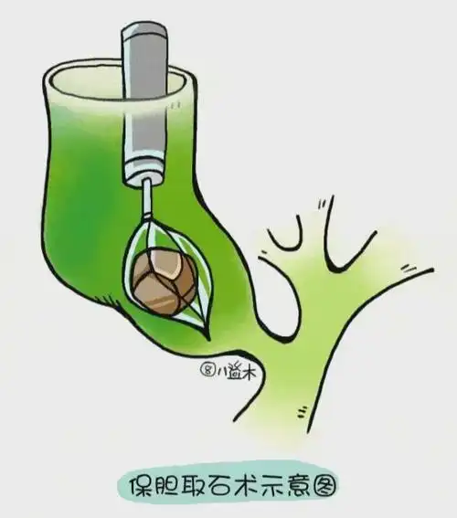 成都胆结石科普:你知道胆囊萎缩后会有哪些并发症?还能保胆吗?