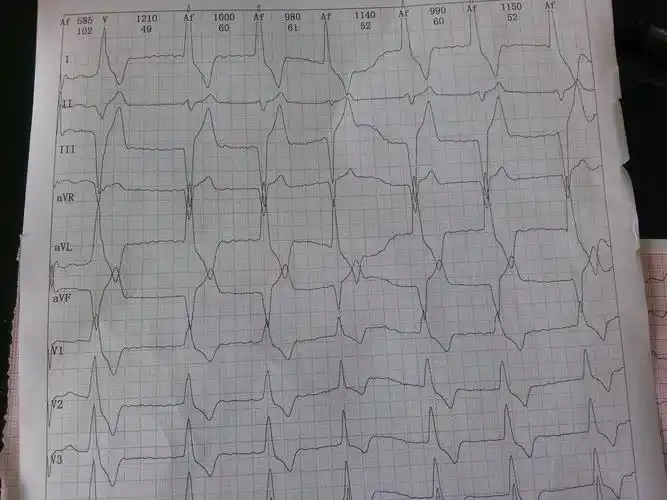 室性逸搏 - 心电图脑电图专业讨论版 - 爱爱医医学论坛