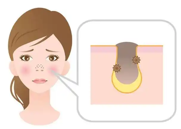 毛孔堵塞如何拯救?最全指南来啦