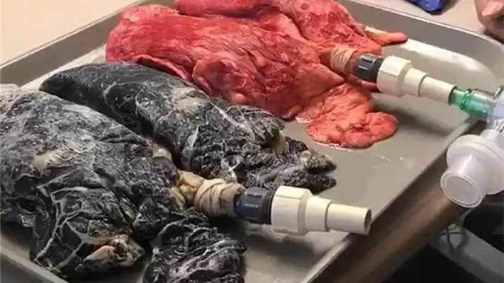 视频吓人20年老烟民的肺与健康的肺区别究竟有多大