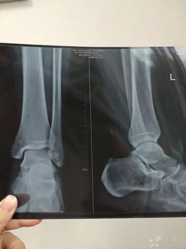 请骨科战友帮忙看一下左踝关节x线片 [病例帖]