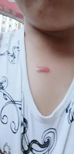 胸口长了硬疙瘩,这是什么东西