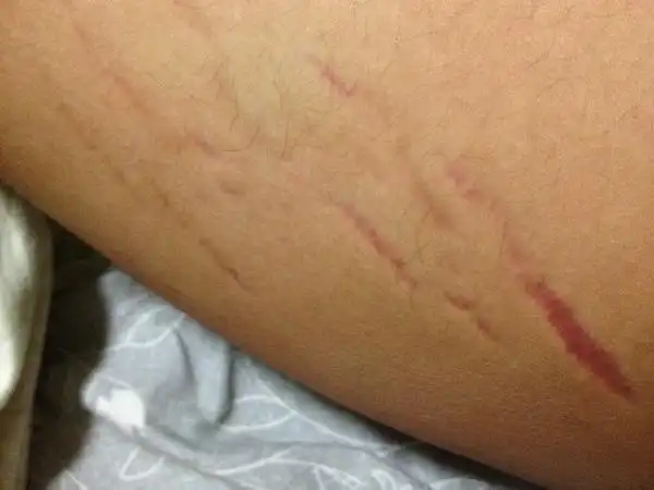 大腿内侧出现红色印记象手抓的一样