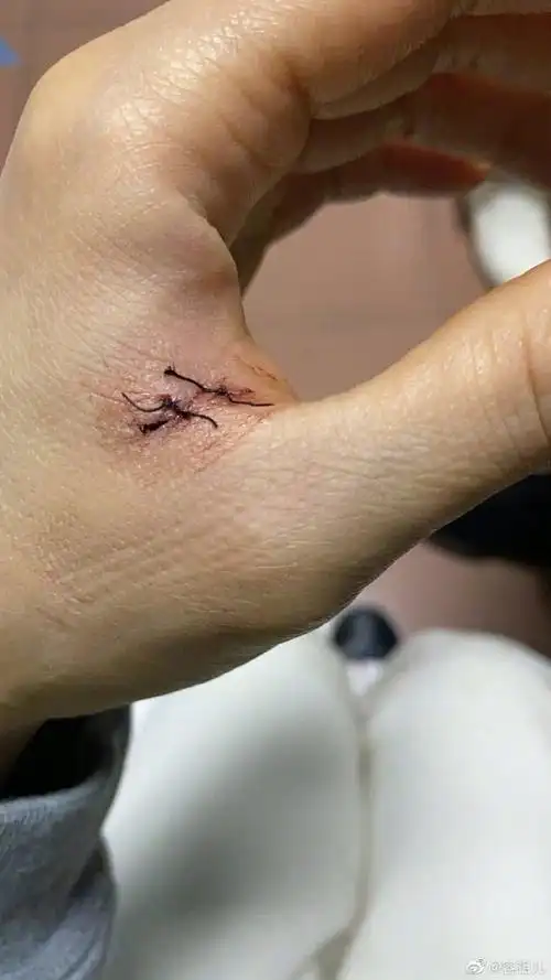 容祖儿左手缝针##容祖儿误伤左手