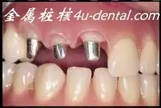 前牙金属桩核2口腔固定修复工艺技术