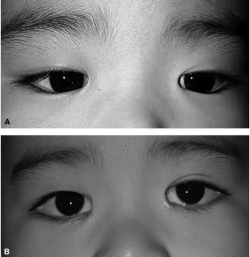 让妈妈们困扰的倒睫,是怎么一回事?