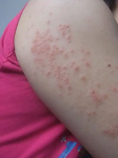 谁能帮我看看这是种什么皮肤病