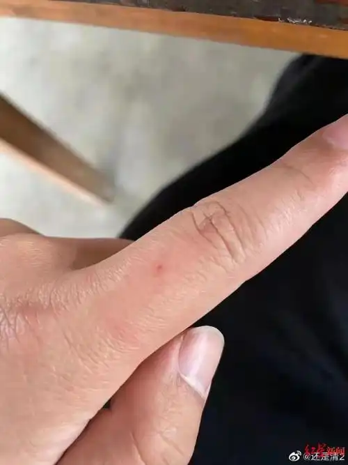 网购新衣藏针扎伤手指客服到医院去检查晚了伤口就闭合了