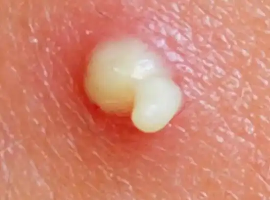 痘痘挤出来的白色物质是什么