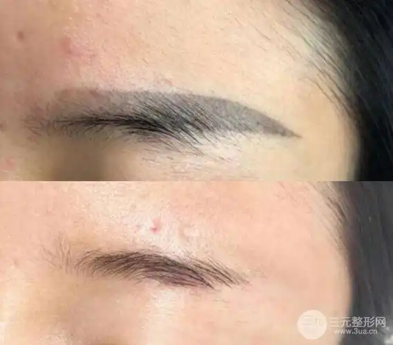 激光洗眉图片揭秘 纹眉失败不用怕!洗掉重来