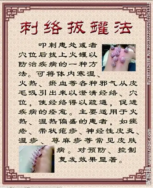 刺络拔罐法展板