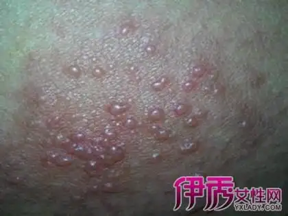 【图】早期淋病图片 3个步骤教你有效治疗淋病