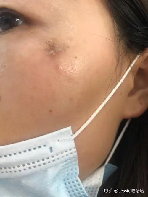 手术切除粉瘤皮脂腺囊肿是一种什么样的体验