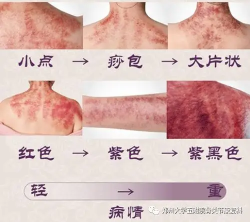 其它 医者仁心为患者 中医刮痧显奇效 写美篇◆◆铜砭刮痧痧象解读