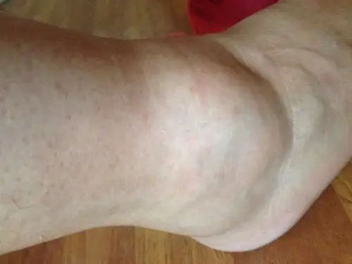 紧急求救下楼梯一脚踩空脚踝肿了个大包