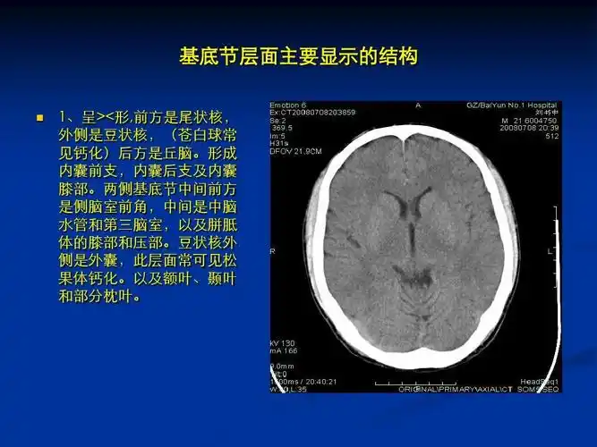 颅脑ct影像断层解剖ppt
