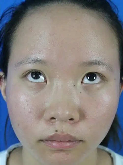 【术前】我其实是双眼皮,但是内眦赘皮比较严重,弧度_圈子-新氧美容