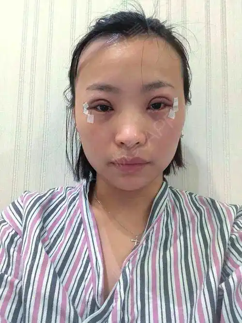 全切双眼皮手术当天_眼部多项手术当天_双眼皮手术当天_眼部整形手术